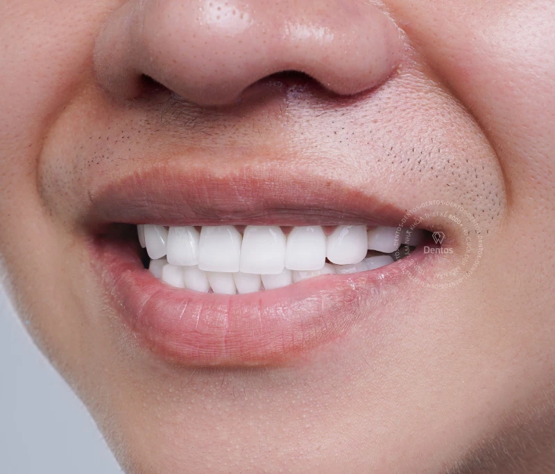 Răng sứ tháo ra có lắp lại được không? Tháo răng sứ bằng cách nào?